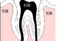 신경 둔한 잇몸, 나중에 큰 일 낸다